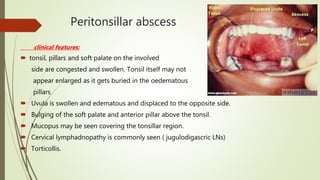 Peritonsillar abscess
clinical features:
 tonsil, pillars and soft palate on the involved
side are congested and swollen. Tonsil itself may not
appear enlarged as it gets buried in the oedematous
pillars
 Uvula is swollen and edematous and displaced to the opposite side.
 Bulging of the soft palate and anterior pillar above the tonsil.
 Mucopus may be seen covering the tonsillar region.
 Cervical lymphadnopathy is commonly seen ( jugulodigascric LNs)
 Torticollis.
 