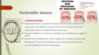 Peritonsillar abscess
Incision & drainage
 Peritonsillar abscess is opened at the point of maximum bulge above the
upper pole or just lateral to the point of junction of anterior pillar and a
horizontal line drawn through the base of the uvula
 Interval tonsillectomy.. Tonsils are removed 4 to 6 wks following an attack of
quinsy.
 Abscess or hot tonsillectomy.. Some surgeons do it instead of incision and
drainage, but it has the risk of abscess rupture during anaesthesia, and
excessive bleeding at the time of operation
 