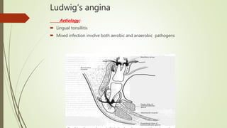 Ludwig’s angina
Aetiology:
 Lingual tonsillitis
 Mixed infection involve both aerobic and anaerobic pathogens
 