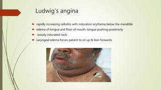 Ludwig’s angina
 rapidly increasing cellulitis with induration erythema below the mandible
 edema of tongue and floor of mouth; tongue pushing posteriorly
 woody indurated neck.
 Laryngeal edema forces patient to sit up & lean forwards
 