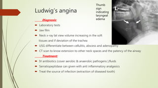 Ludwig’s angina
Diagnosis:
 Laboratory tests
 Jaw film
 Neck x-ray lat view volume increasing in the soft
tissues and if deviation of the trachea
 USG differentiate between cellulitis, abscess and adenopathy
 CT scan to know extension to other neck spaces and the patency of the airway
Treatment:
 IV antibiotics (cover aerobic & anaerobic pathogens ),fluids
 Serratiopeptidase can given with anti inflammatory analgesics
 Treat the source of infection (extraction of diseased tooth)
Thumb
sign
indicating
laryngeal
edema
 