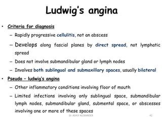 Ludwig’s angina
• Criteria for diagnosis
– Rapidly progressive cellulitis, not an abscess
– Develops along fascial planes by direct spread, not lymphatic
spread
– Does not involve submandibular gland or lymph nodes
– Involves both sublingual and submaxillary spaces, usually bilateral
• Pseudo – ludwig’s angina
– Other inflammatory conditions involving floor of mouth
– Limited infections involving only sublingual space, submandibular
lymph nodes, submandibular gland, submental space, or abscesses
involving one or more of these spaces
42
Dr. ASHLY ALEXANDER
 