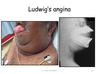 Ludwig’s angina
45
Dr. ASHLY ALEXANDER
 