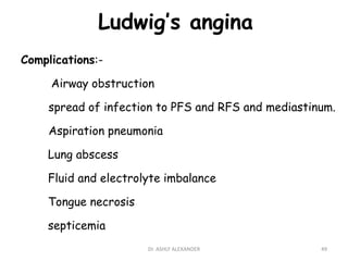 Ludwig’s angina
Complications:-
Airway obstruction
spread of infection to PFS and RFS and mediastinum.
Aspiration pneumonia
Lung abscess
Fluid and electrolyte imbalance
Tongue necrosis
septicemia
49
Dr. ASHLY ALEXANDER
 