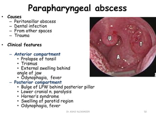 Parapharyngeal abscess
• Causes
– Peritonsillar abscess
– Dental infection
– From other spaces
– Trauma
• Clinical features
– Anterior compartment
• Prolapse of tonsil
• Trismus
• External swelling behind
angle of jaw
• Odynophagia, fever
– Posterior compartment
• Bulge of LPW behind posterior pillar
• Lower cranial n. paralysis
• Horner’s syndrome
• Swelling of parotid region
• Odynophagia, fever
50
Dr. ASHLY ALEXANDER
 