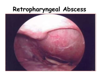 Retropharyngeal Abscess
56
Dr. ASHLY ALEXANDER
 