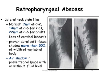 Retropharyngeal Abscess
• Lateral neck plain film
– Normal: 7mm at C-2,
14mm at C-6 for kids,
22mm at C-6 for adults
– Loss of cervical lordosis
– prevertebral soft tissue
shadow more than 50%
of width of vertebral
body
– Air shadow in
prevertebral space with
or without fluid level
59
Dr. ASHLY ALEXANDER
 