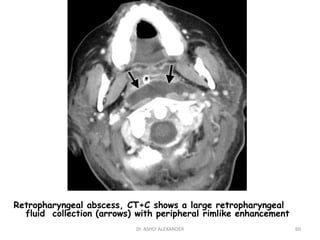 Retropharyngeal abscess, CT+C shows a large retropharyngeal
fluid collection (arrows) with peripheral rimlike enhancement
60
Dr. ASHLY ALEXANDER
 