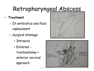 Retropharyngeal Abscess
• Treatment
– IV antibiotics and fluid
replacement
– Surgical drainage
• Intraoral
• External –
tracheostomy +
anterior cervical
approach
61
Dr. ASHLY ALEXANDER
 