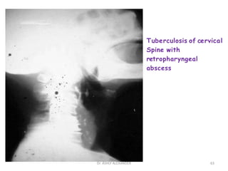 Tuberculosis of cervical
Spine with
retropharyngeal
abscess
63
Dr. ASHLY ALEXANDER
 
