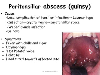 Peritonsillar abscess (quinsy)
• Cause
-Local complication of tonsillar infection→ Lacunar type
-Infection→crypta magna→paratonsillar space
-Weber’ glands infection
-De novo
• Symptoms
– Fever with chills and rigor
– Odynophagia
– “Hot Potato” voice
– Halitosis
– Head tilted towards affected site
67
Dr. ASHLY ALEXANDER
 