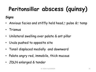 Peritonsillar abscess (quinsy)
Signs
• Anxious facies and stiffly held head,↑ pulse &↑ temp
• Trismus
• Unilateral swelling over palate & ant pillar
• Uvula pushed to opposite site
• Tonsil displaced medially and downward
• Palate angry red, immobile, thick mucous
• JDLN enlarged & tender
70
Dr. ASHLY ALEXANDER
 