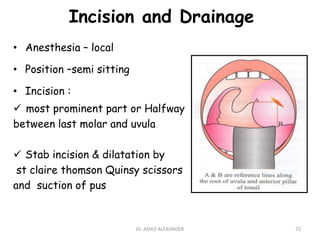 • Anesthesia – local
• Position –semi sitting
• Incision :
 most prominent part or Halfway
between last molar and uvula
 Stab incision & dilatation by
st claire thomson Quinsy scissors
and suction of pus
Incision and Drainage
72
Dr. ASHLY ALEXANDER
 
