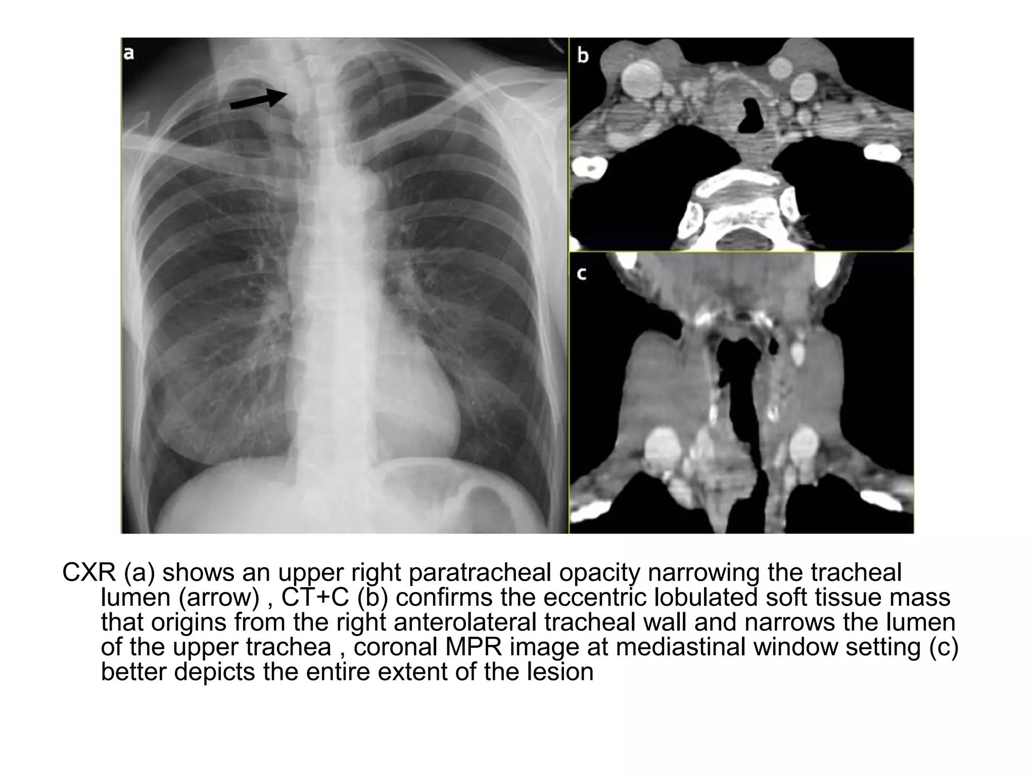 CXR (a) shows an upper right paratracheal opacity narrowing the tracheal
lumen (arrow) , CT+C (b) confirms the eccentric lobulated soft tissue mass
that origins from the right anterolateral tracheal wall and narrows the lumen
of the upper trachea , coronal MPR image at mediastinal window setting (c)
better depicts the entire extent of the lesion
 