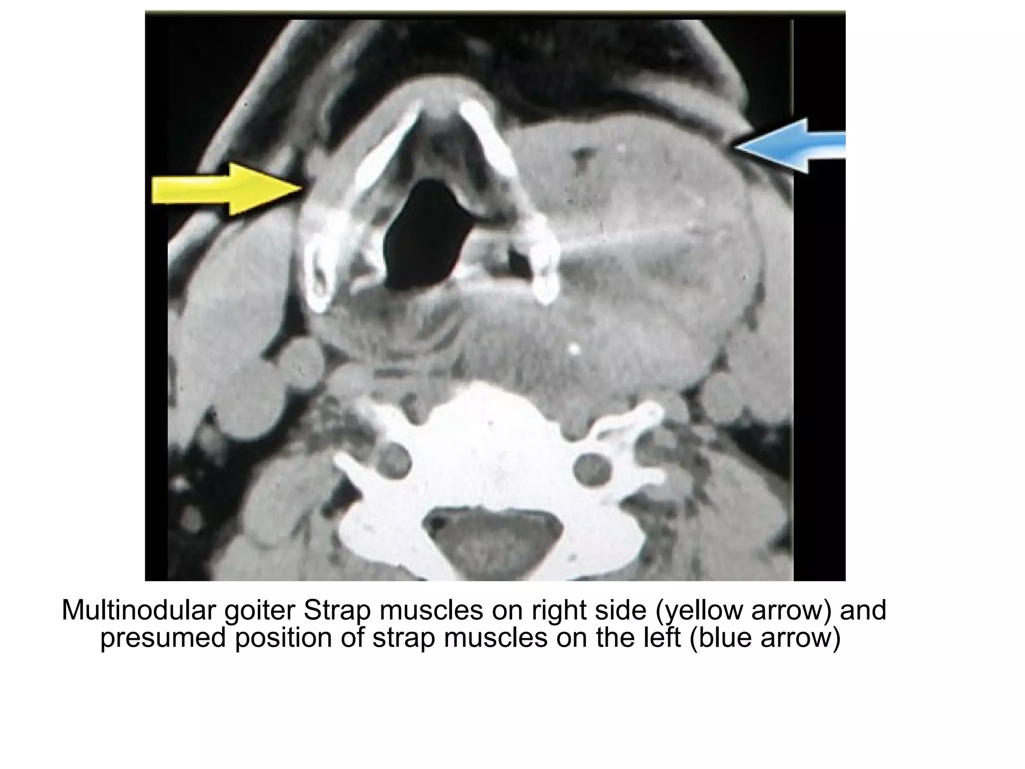 Multinodular goiter Strap muscles on right side (yellow arrow) and
presumed position of strap muscles on the left (blue arrow)
 