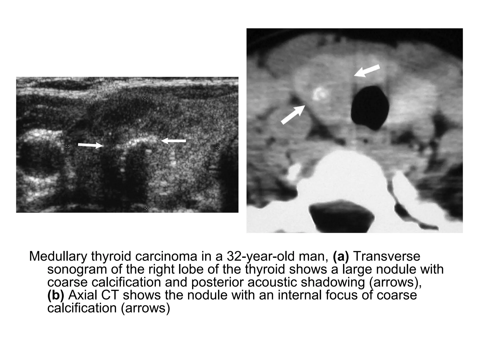 Medullary thyroid carcinoma in a 32-year-old man, (a) Transverse
sonogram of the right lobe of the thyroid shows a large nodule with
coarse calcification and posterior acoustic shadowing (arrows),
(b) Axial CT shows the nodule with an internal focus of coarse
calcification (arrows)
 