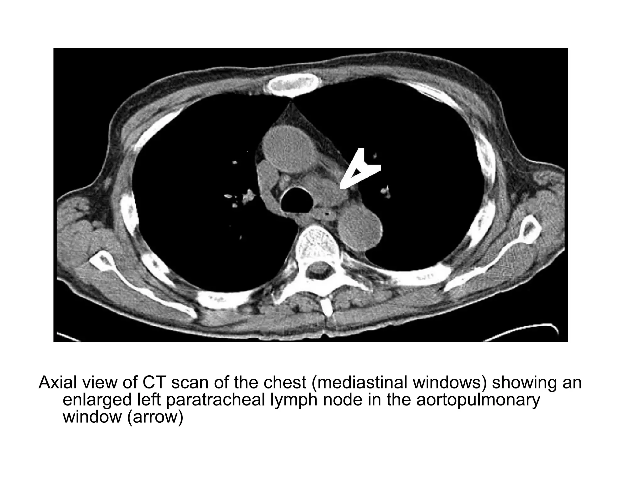 Axial view of CT scan of the chest (mediastinal windows) showing an
enlarged left paratracheal lymph node in the aortopulmonary
window (arrow)
 