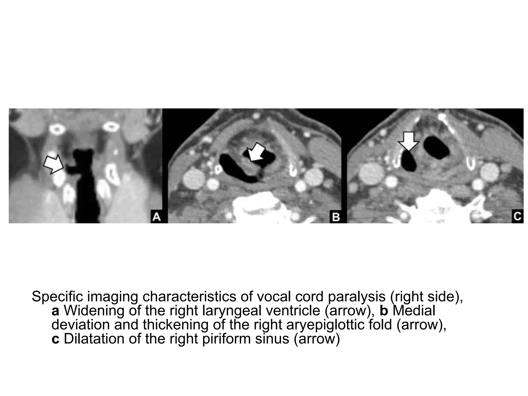 Specific imaging characteristics of vocal cord paralysis (right side),
a Widening of the right laryngeal ventricle (arrow), b Medial
deviation and thickening of the right aryepiglottic fold (arrow),
c Dilatation of the right piriform sinus (arrow)
 