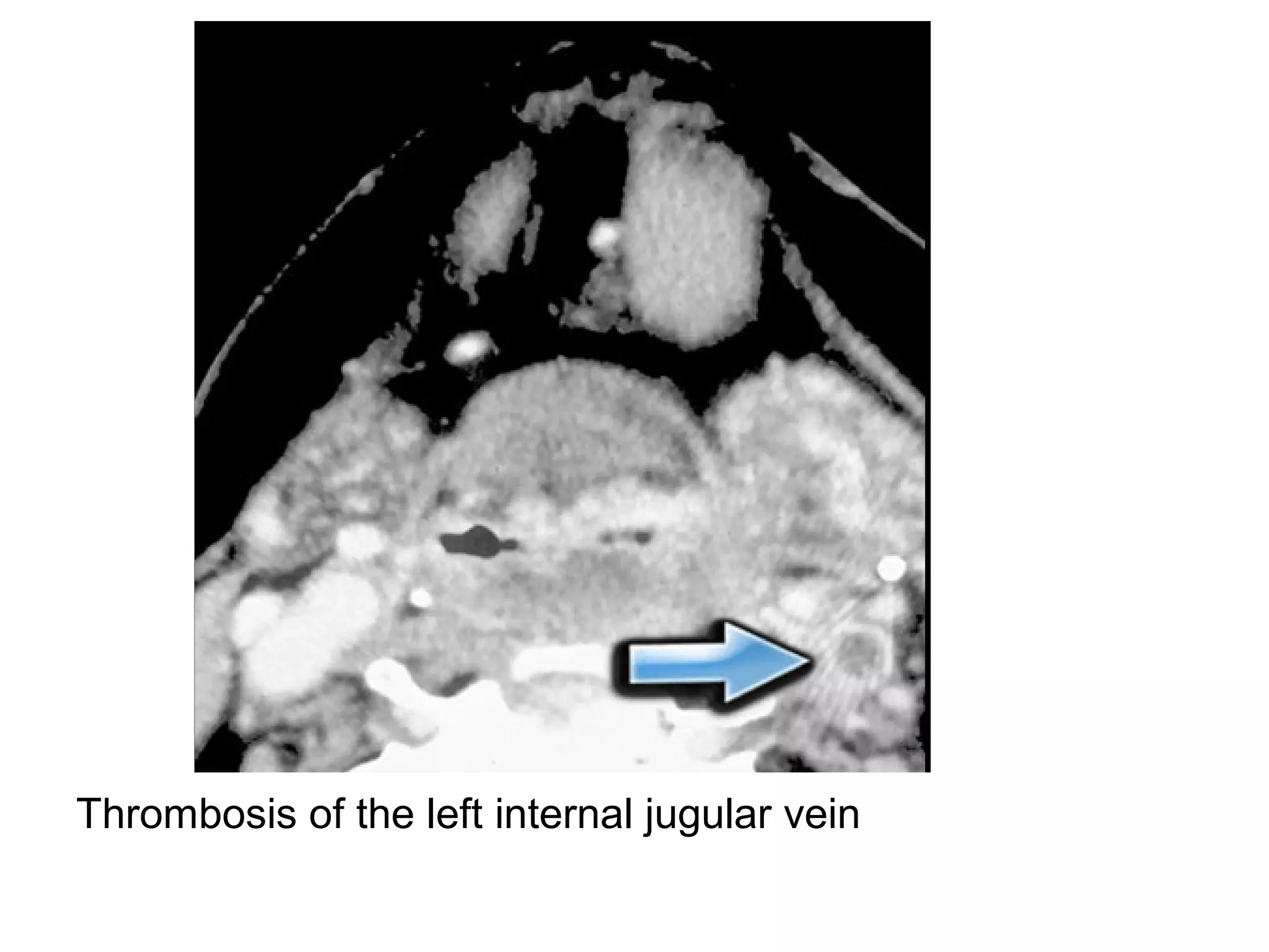 Thrombosis of the left internal jugular vein
 