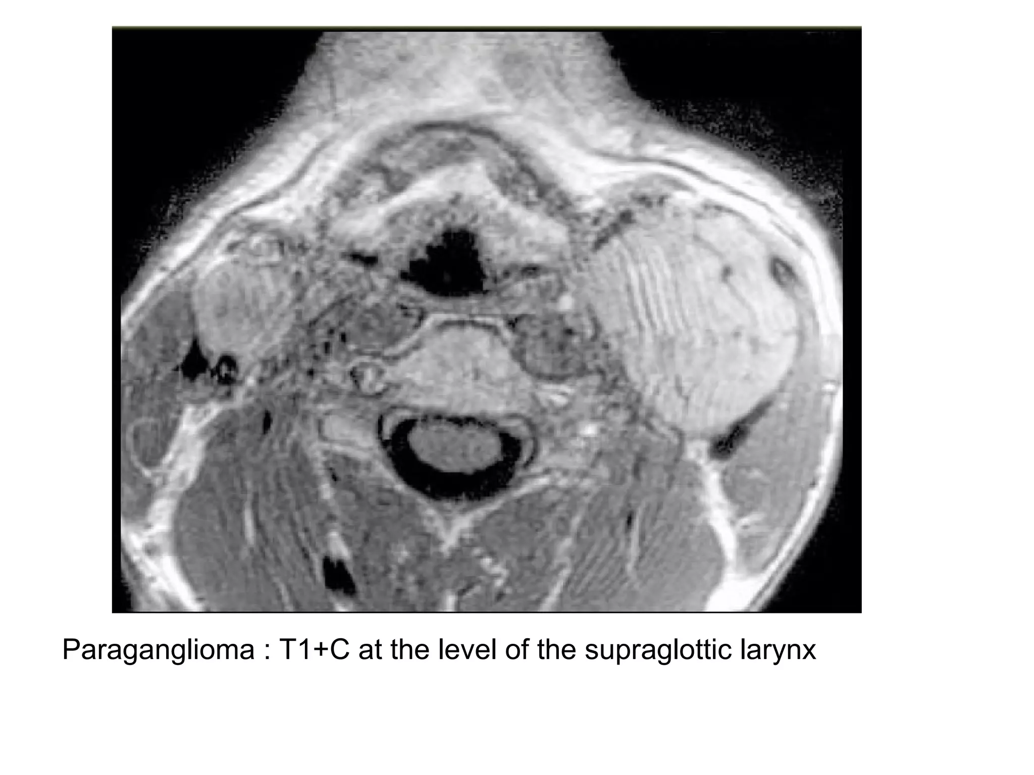 Paraganglioma : T1+C at the level of the supraglottic larynx
 