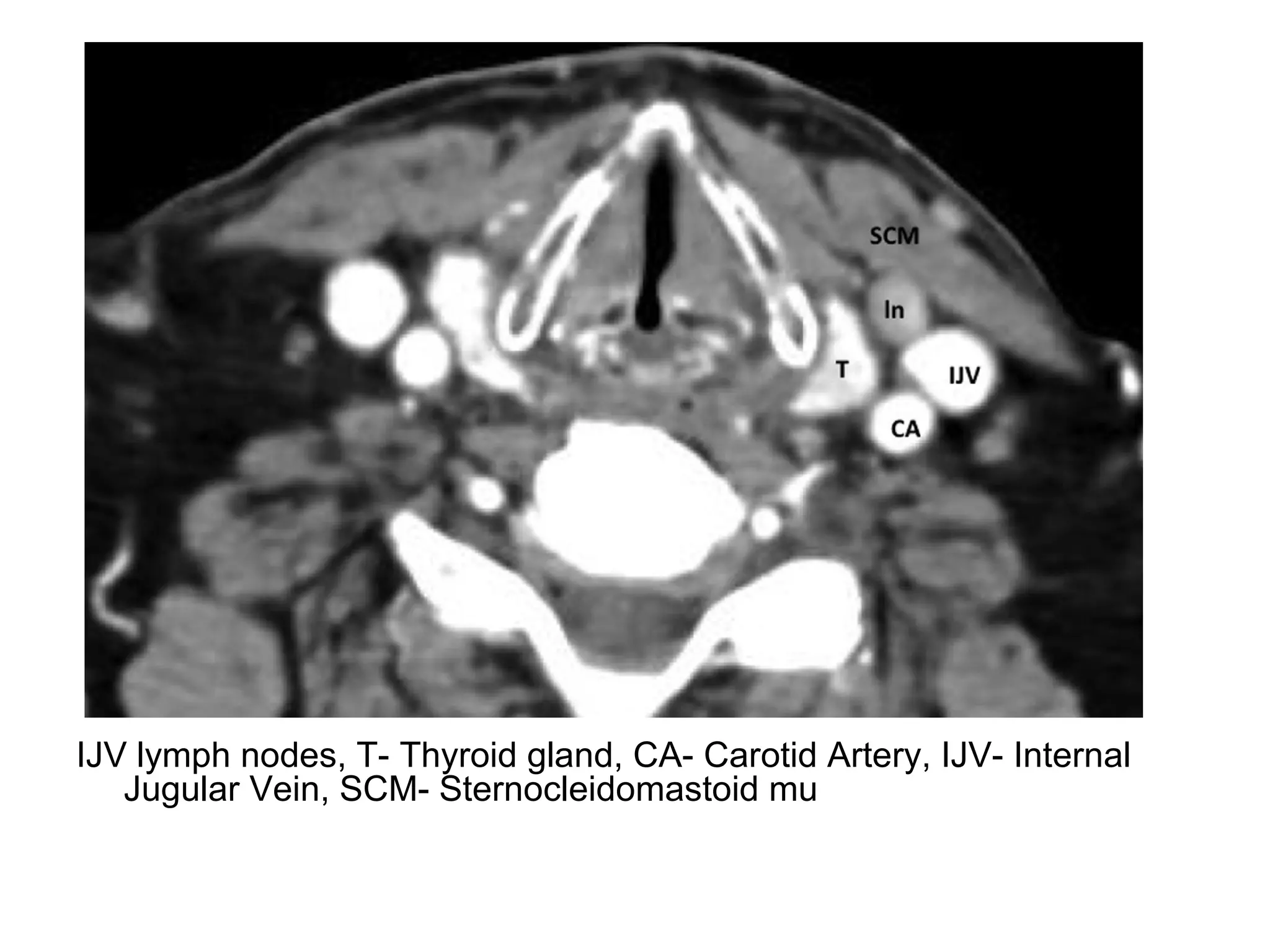 IJV lymph nodes, T- Thyroid gland, CA- Carotid Artery, IJV- Internal
Jugular Vein, SCM- Sternocleidomastoid mu
 