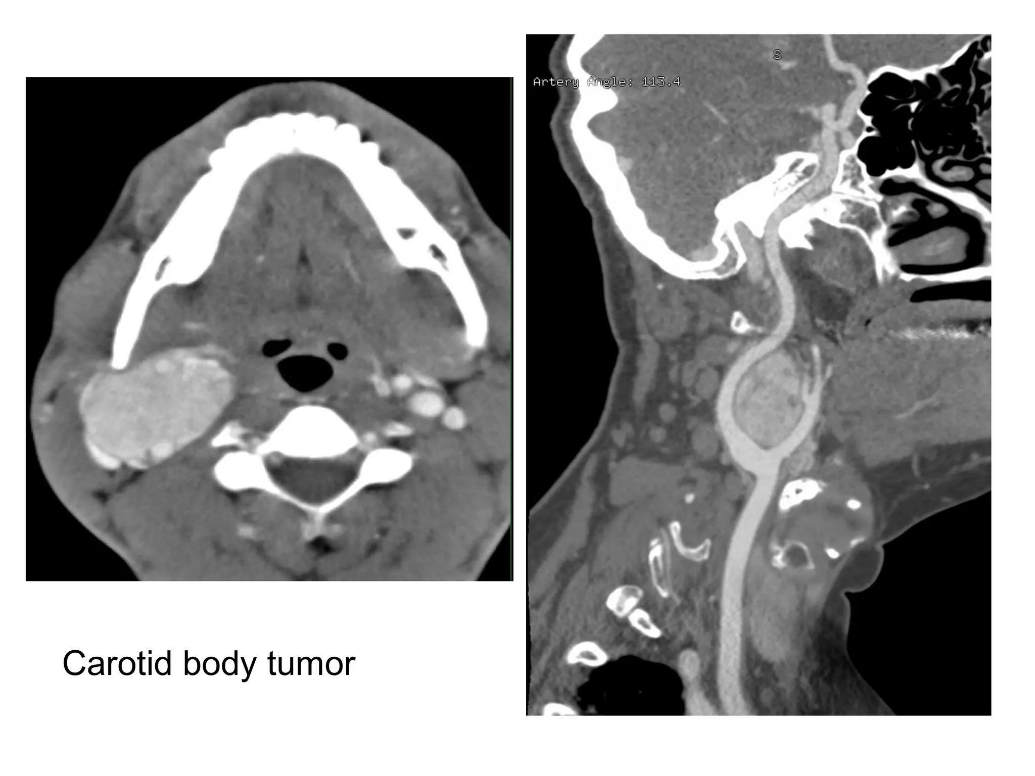 Carotid body tumor
 