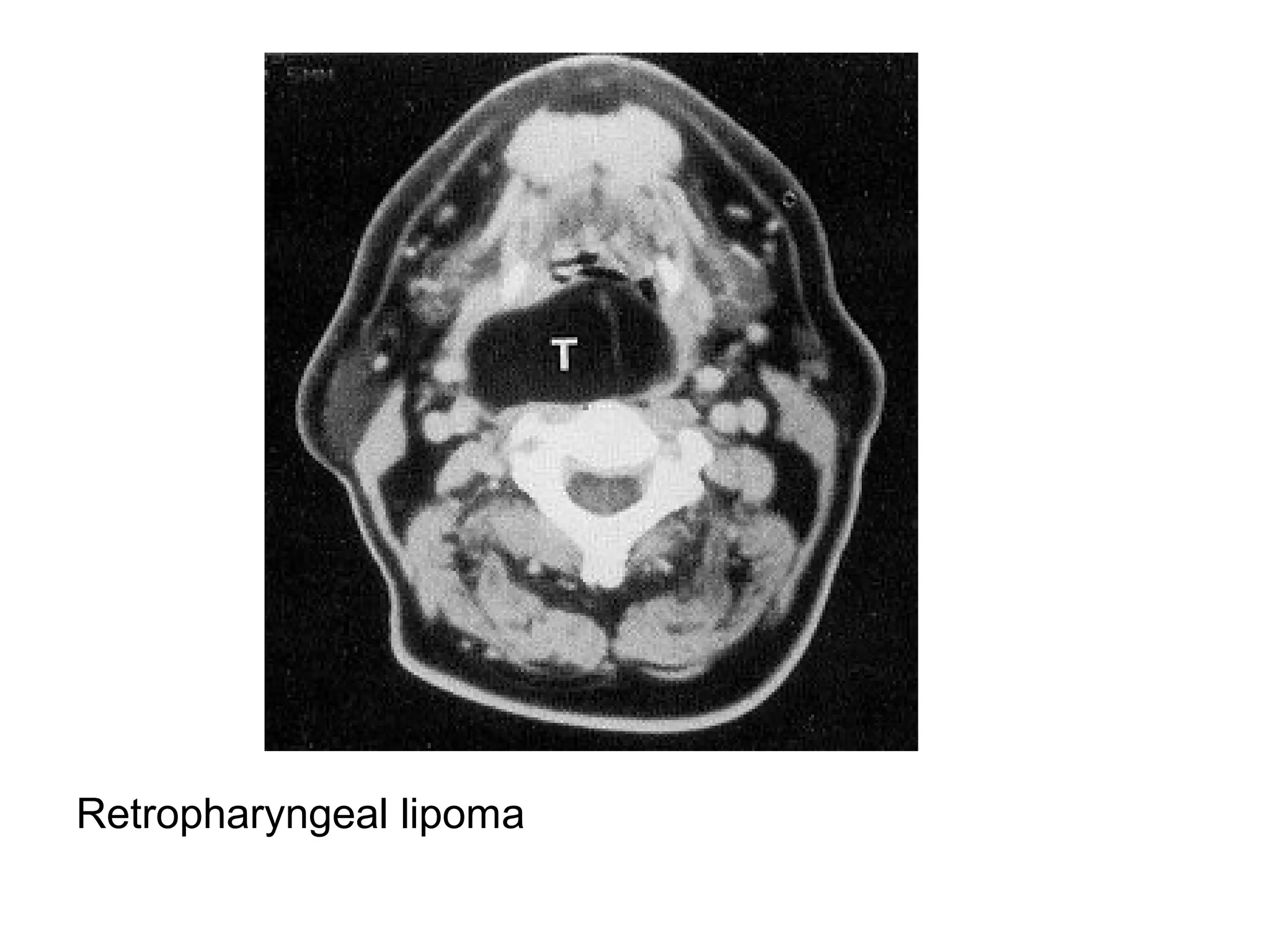 Retropharyngeal lipoma
 