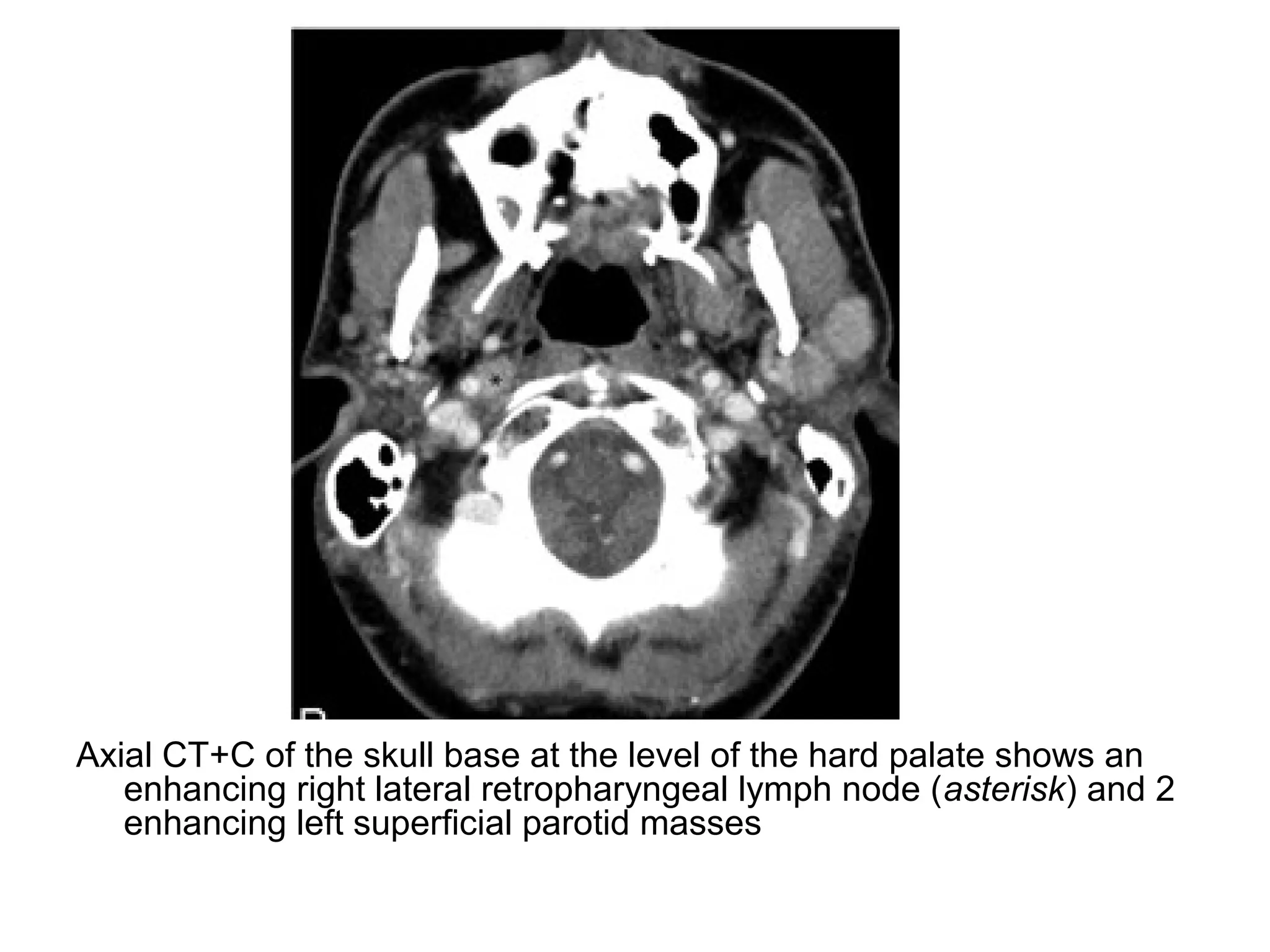 Axial CT+C of the skull base at the level of the hard palate shows an
enhancing right lateral retropharyngeal lymph node (asterisk) and 2
enhancing left superficial parotid masses
 