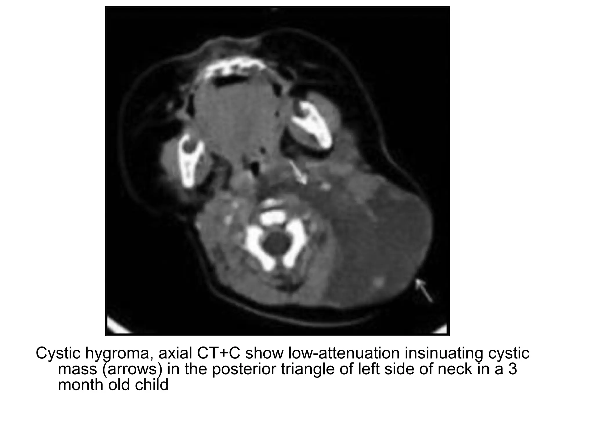 Cystic hygroma, axial CT+C show low-attenuation insinuating cystic
mass (arrows) in the posterior triangle of left side of neck in a 3
month old child
 