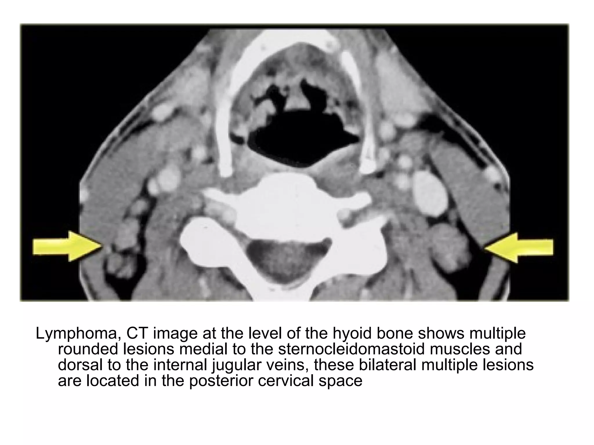 Lymphoma, CT image at the level of the hyoid bone shows multiple
rounded lesions medial to the sternocleidomastoid muscles and
dorsal to the internal jugular veins, these bilateral multiple lesions
are located in the posterior cervical space
 