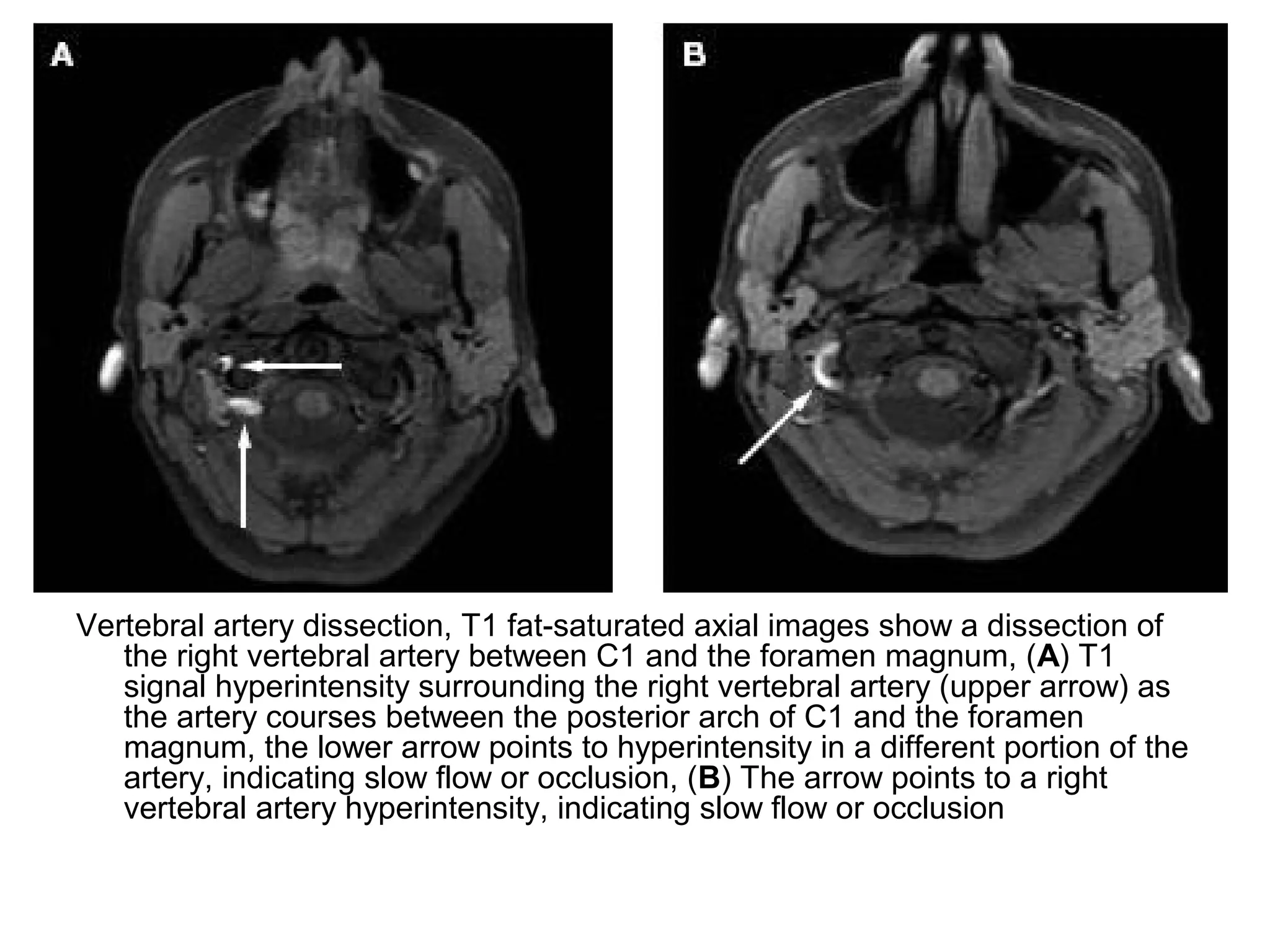Vertebral artery dissection, T1 fat-saturated axial images show a dissection of
the right vertebral artery between C1 and the foramen magnum, (A) T1
signal hyperintensity surrounding the right vertebral artery (upper arrow) as
the artery courses between the posterior arch of C1 and the foramen
magnum, the lower arrow points to hyperintensity in a different portion of the
artery, indicating slow flow or occlusion, (B) The arrow points to a right
vertebral artery hyperintensity, indicating slow flow or occlusion
 