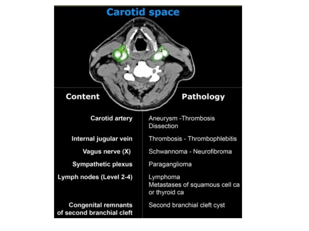 Diagnostic Imaging of Deep Neck Spaces