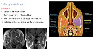 Contents of masticator space
Contents:-
• Muscles of mastication
• Ramus and body of mandible
• Mandibular division of trigeminal nerve
it enters masticator space via foramen ovale
 
