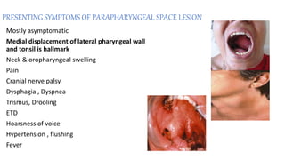 PRESENTING SYMPTOMS OF PARAPHARYNGEAL SPACE LESION
Mostly asymptomatic
Medial displacement of lateral pharyngeal wall
and tonsil is hallmark
Neck & oropharyngeal swelling
Pain
Cranial nerve palsy
Dysphagia , Dyspnea
Trismus, Drooling
ETD
Hoarsness of voice
Hypertension , flushing
Fever
 