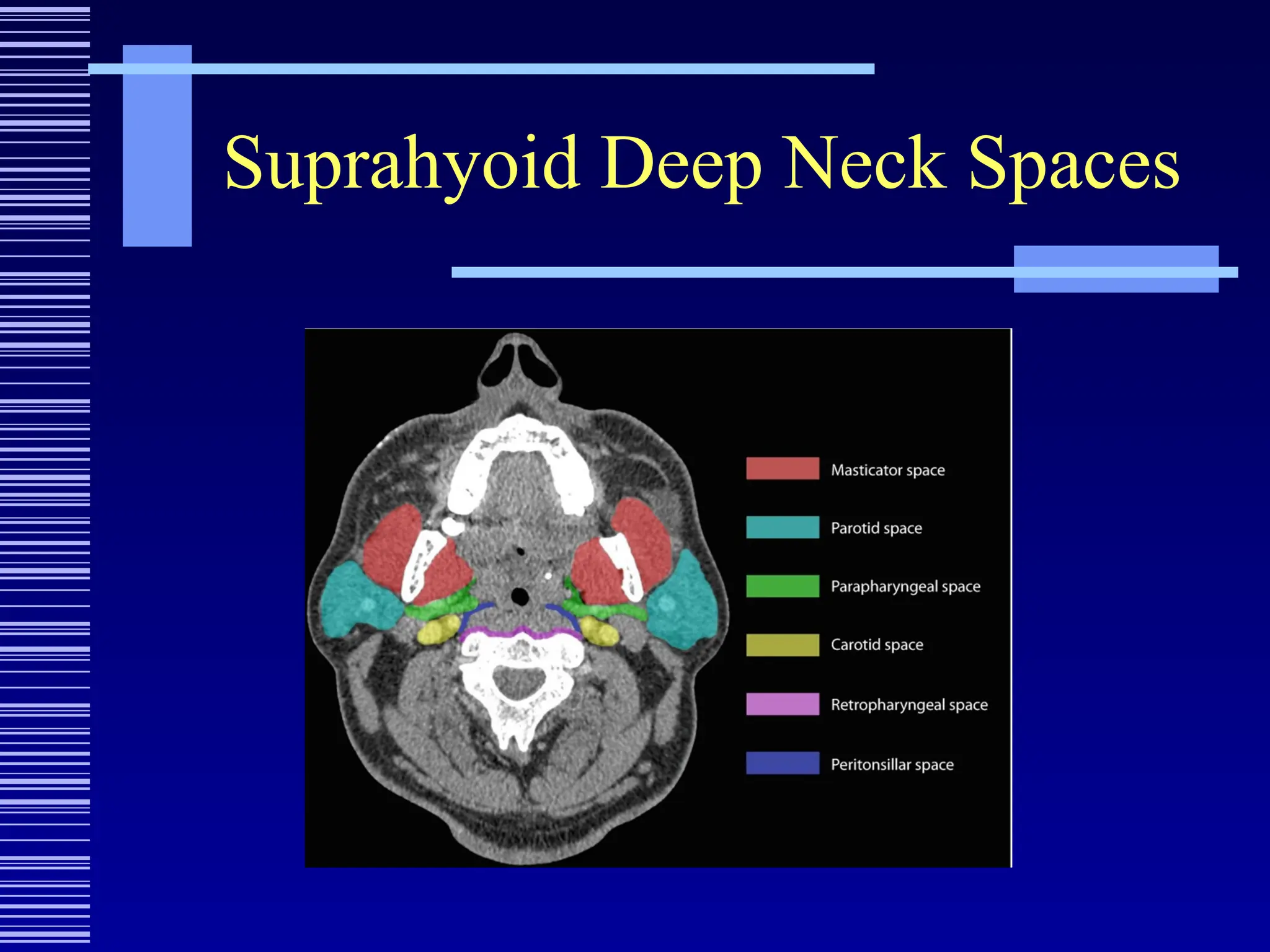 Suprahyoid Deep Neck Spaces
 