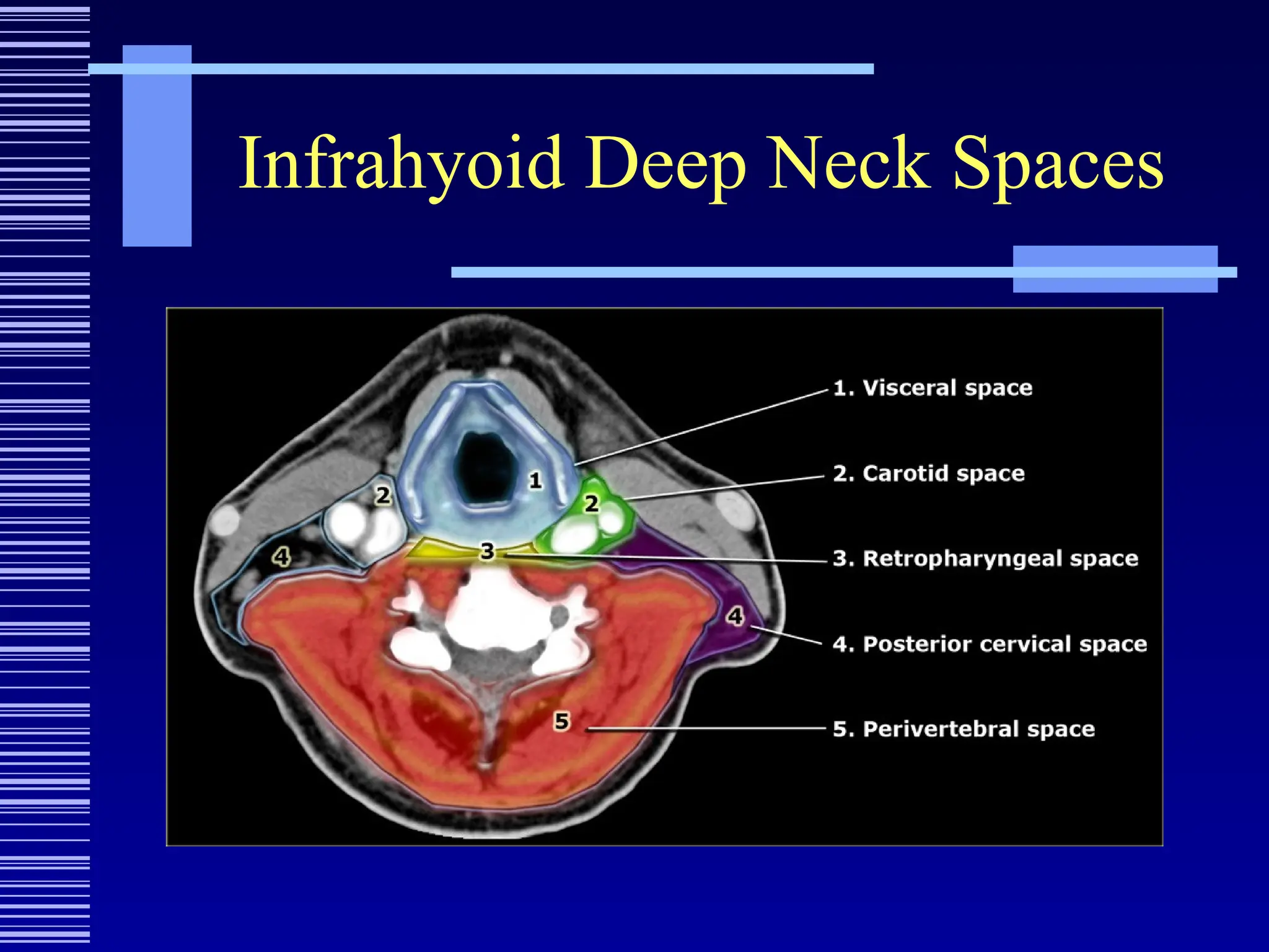 Infrahyoid Deep Neck Spaces
 