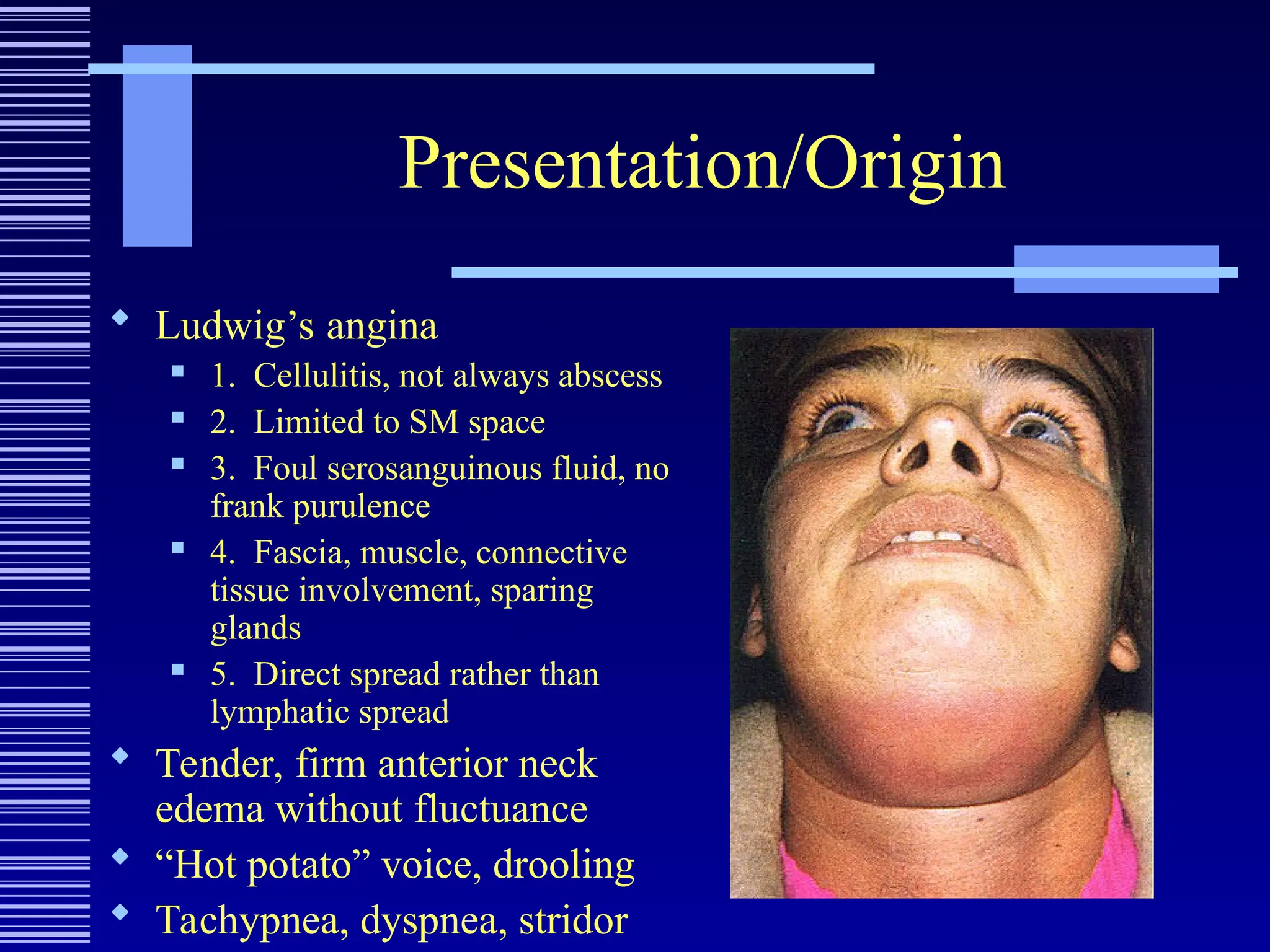Presentation/Origin
 Ludwig’s angina
 1. Cellulitis, not always abscess
 2. Limited to SM space
 3. Foul serosanguinous fluid, no
frank purulence
 4. Fascia, muscle, connective
tissue involvement, sparing
glands
 5. Direct spread rather than
lymphatic spread
 Tender, firm anterior neck
edema without fluctuance
 “Hot potato” voice, drooling
 Tachypnea, dyspnea, stridor
 