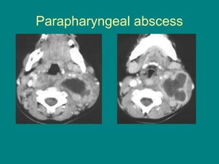 Neck Abscess Radiology Deep space neck infection . | PPTX