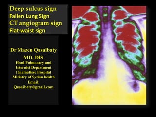 Deep sulcus sign
Fallen Lung Sign
CT angiogram sign
Flat-waist sign
Dr Mazen Qusaibaty
MD, DIS
Head Pulmonary and
Internist Department
Ibnalnafisse Hospital
Ministry of Syrian health
Email:
Qusaibaty@gmail.com
 