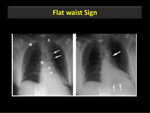 sulcus angiogram lobe