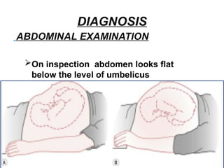 DIAGNOSIS
ABDOMINAL EXAMINATION
On inspection abdomen looks flat
below the level of umbelicus
 