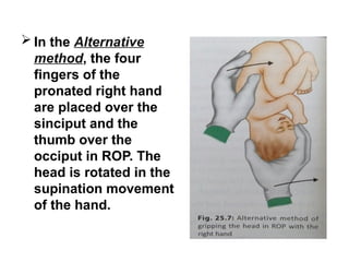  In the Alternative
method, the four
fingers of the
pronated right hand
are placed over the
sinciput and the
thumb over the
occiput in ROP. The
head is rotated in the
supination movement
of the hand.
 
