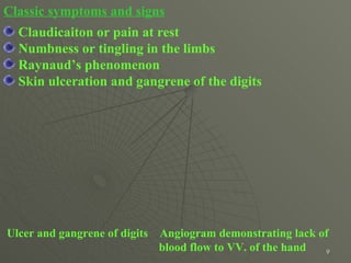 Classic symptoms and signs Claudicaiton or pain at rest Numbness or tingling in the limbs  Raynaud’s phenomenon Skin ulceration and gangrene of the digits  Ulcer and gangrene of digits  Angiogram demonstrating lack of      blood flow to   VV. of the hand 