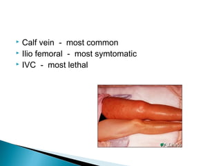  Calf vein - most common
 Ilio femoral - most symtomatic
 IVC - most lethal
 