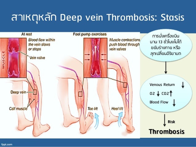 Deep Vein Thrombosis