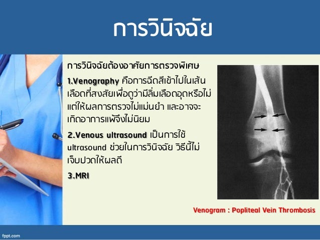 Deep Vein Thrombosis