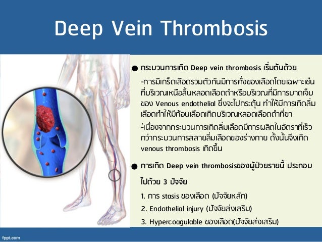 Deep Vein Thrombosis Deep Vein Thrombosis