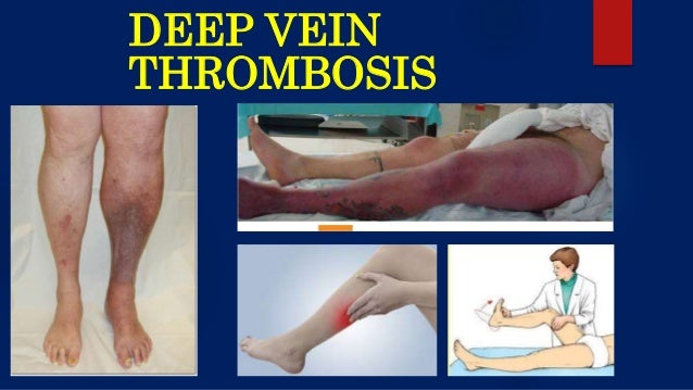 Deep Vein Thrombosis Venous Diseases deep-vein-thrombosis-venous-diseases