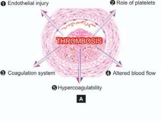 Dvt Racgp Deep vein thrombosis (DVT) | PPTX