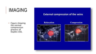 Deep Vein Thrombosis | PPT
